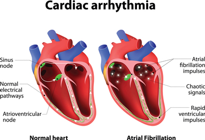 Diagram Explaining Cardiac Arrhythmia